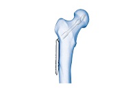 LCP Dynamic Hip Screw